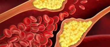 Kolesterol nedir? Kolesterol Nasıl Düşürülür?