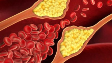 Kolesterol nedir? Kolesterol Nasıl Düşürülür?